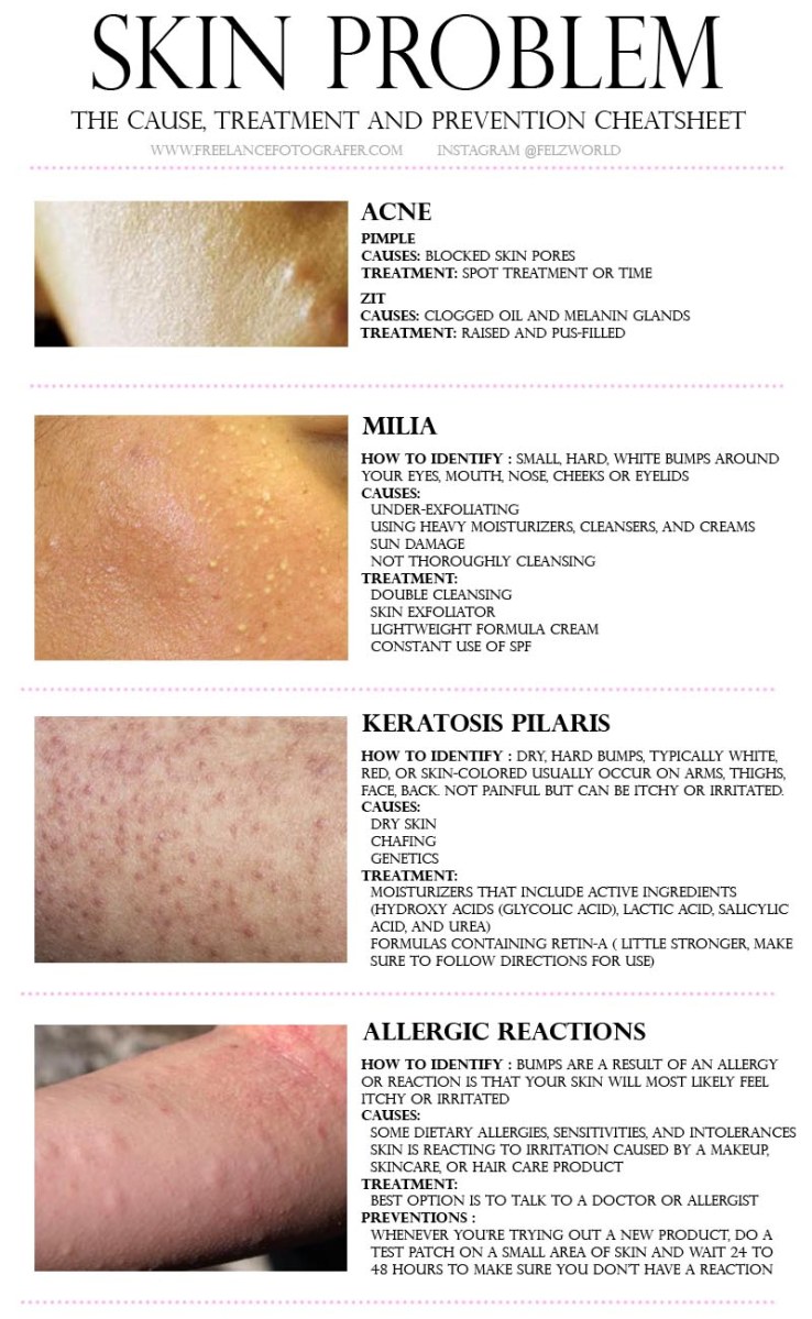 Skin Problems How To Handle Why It Happens And How To Get Clear Skin Everything I Learnt Tried And Bought